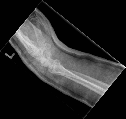 fracture 5 days later lateral.jpg