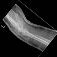 fracture 5 days later lateral.jpg